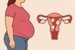 آیا فیبروم باعث چاقی می‌شود؟ بررسی کامل ارتباط فیبروم و افزایش وزن