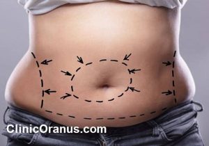 پیکرتراشی تخصصی؛ راهی سریع و ایمن برای حذف چربی های موضعی