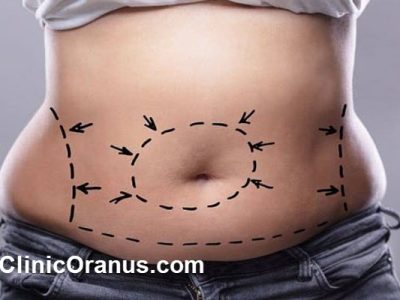 پیکرتراشی تخصصی؛ راهی سریع و ایمن برای حذف چربی های موضعی