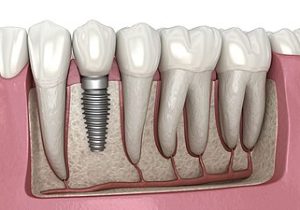 ایمپلنت دیجیتال در زعفرانیه؛ چرا دقت درمان به اندازه کیفیت ایمپلنت اهمیت دارد؟