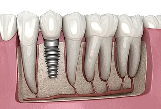 ایمپلنت دیجیتال در زعفرانیه؛ چرا دقت درمان به اندازه کیفیت ایمپلنت اهمیت دارد؟